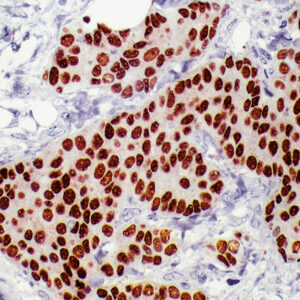 Anti-Estrogen Receptor, ER (InSite?)