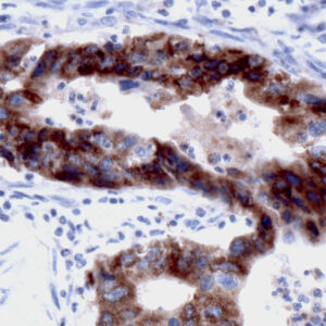 Anti-CD227 (MUCIN 1)