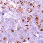 Anti-Mesothelin (Mesothelial Marker)