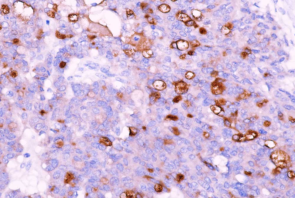 Anti-Mesothelin (Mesothelial Marker)