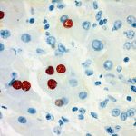 Anti-Hepatitis B Virus Core Antigen