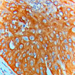IHC on Breast squamous carcinoma
