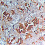 IHC on Neuroendocrine Tumor Tissue