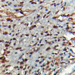 IHC on Prostate carcinoma Tissue