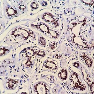 IHC on Breast Tissue