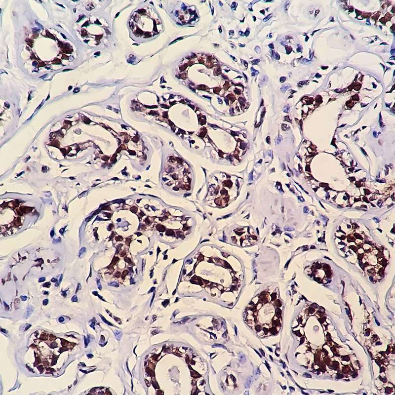 IHC on Breast Tissue