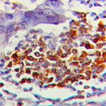 IHC on Colon carcinoma