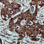 IHC on Colon Carcinoma Tissue