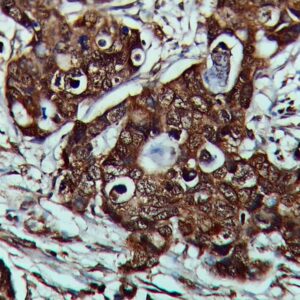 IHC on Colon Carcinoma Tissue