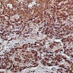 IHC on Appendicitis Tissue