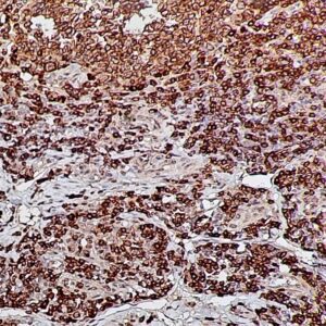 IHC on Appendicitis Tissue