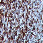 IHC on Squamous Carcinoma Tissue