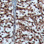 IHC on Transitional Cell Carcinoma Tissue