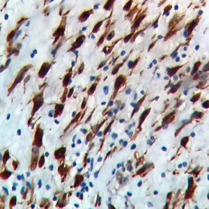 IHC on Squamous Carcinoma of Cervix