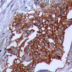 IHC on Tongue Squamopus Cell Carcinoma Tissue
