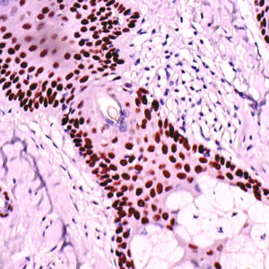 IHC on Skin Basal Cell Carcinoma Tissue
